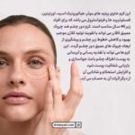 کرم دور چشم لافارر