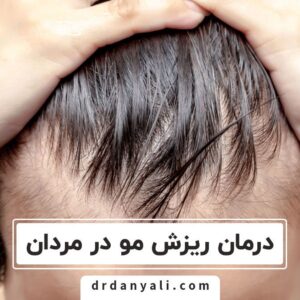 ریزش مو آقایان