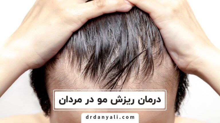 ریزش مو آقایان