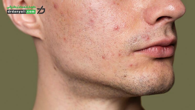 انوع رایج آکنه و نحوه درمان