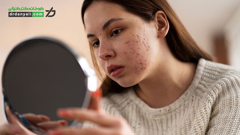 انوع رایج آکنه و نحوه درمان