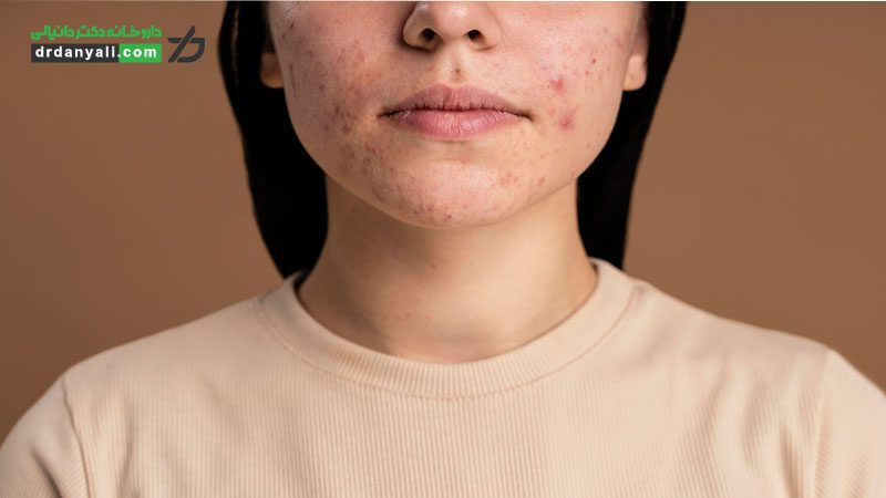 انوع رایج آکنه و نحوه درمان