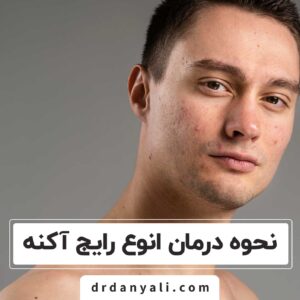 انوع رایج آکنه