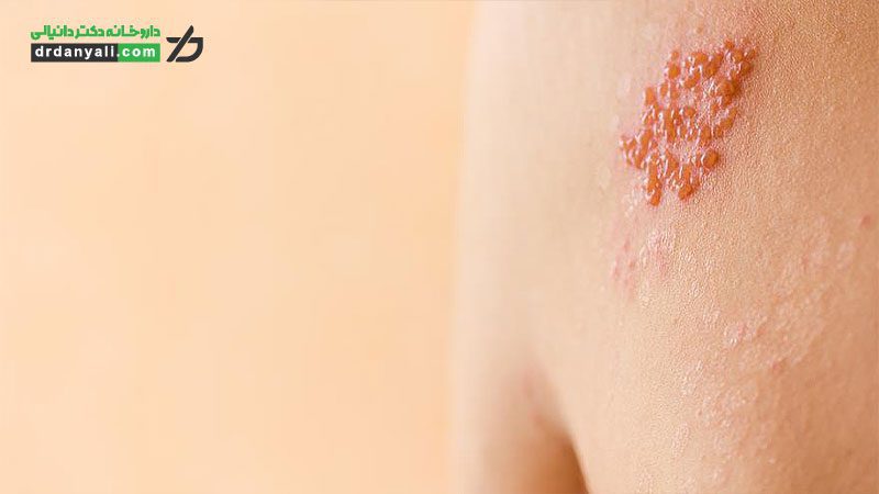 عود مجدد تبخال