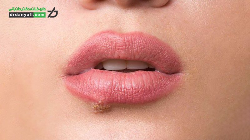 عود مجدد تبخال