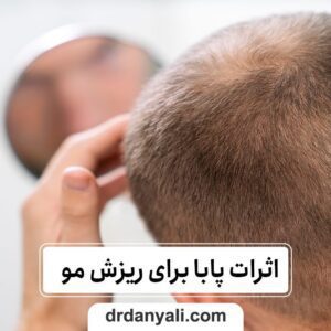 پابا برای ریزش مو