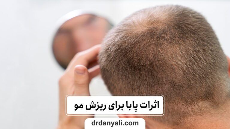 پابا برای ریزش مو