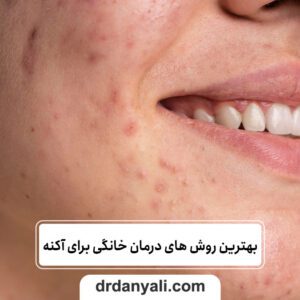 بهترین روش های درمان خانگی برای آکنه