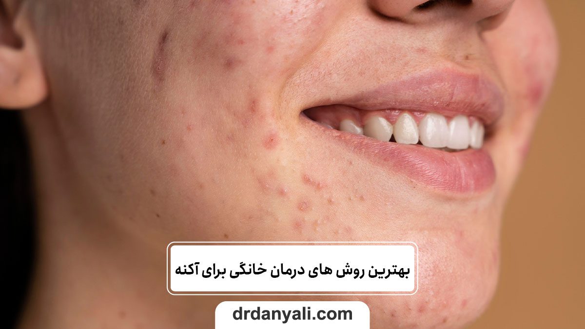 بهترین روش های درمان خانگی برای آکنه