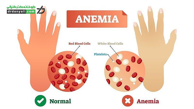 چگونه تشخیص دهیم به مکمل های کم خونی نیاز داریم؟