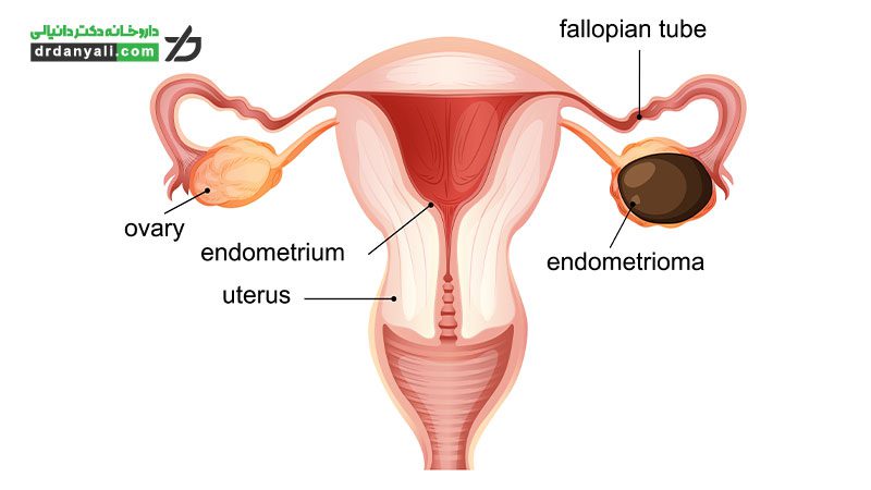 اندومتریوز چیست