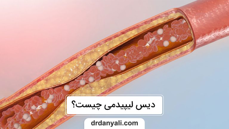 دیس لیپیدمی چیست؟ داروهای موثر در درمان آن