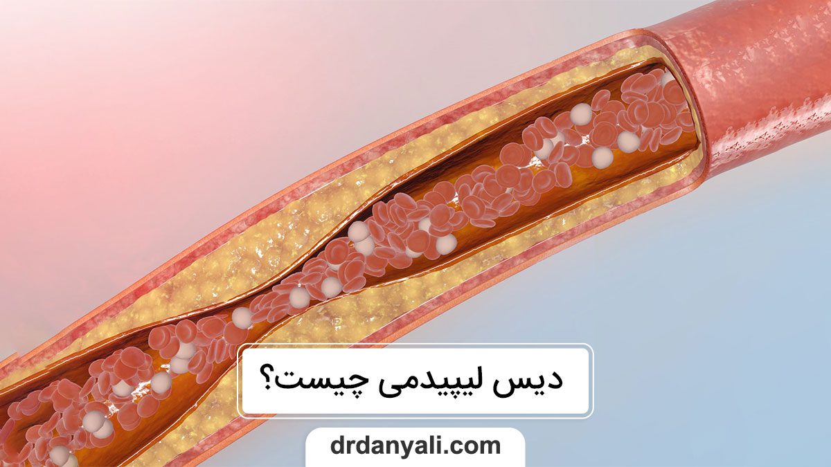 دیس لیپیدمی چیست؟ داروهای موثر در درمان آن