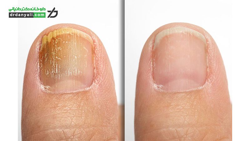 قارچ ناخن