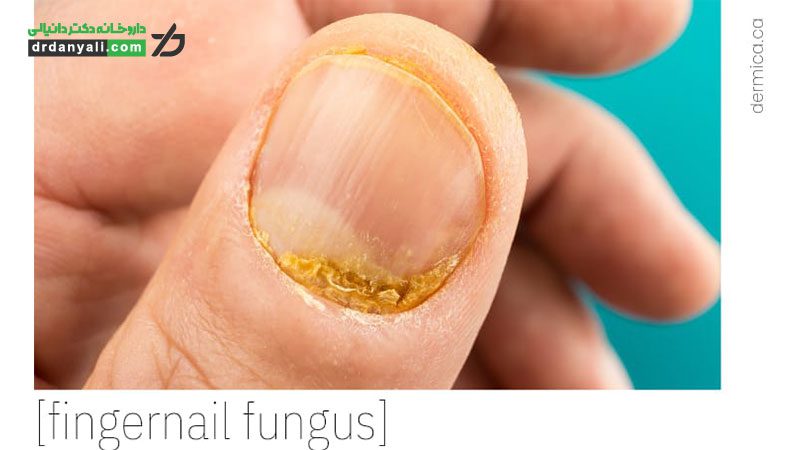 قارچ ناخن