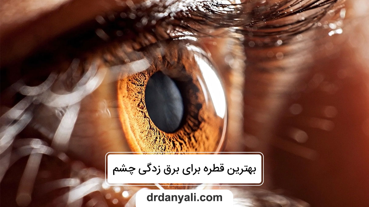 برق زدگی چشم