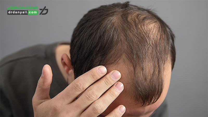 قرص ماینوکسیدیل برای ریزش مو